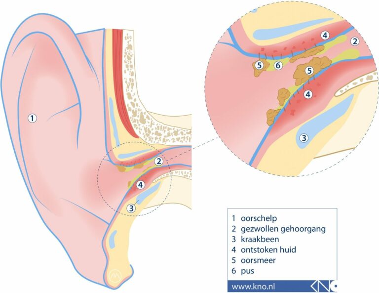 Zwemmersoor Otitis Externa Qdiving